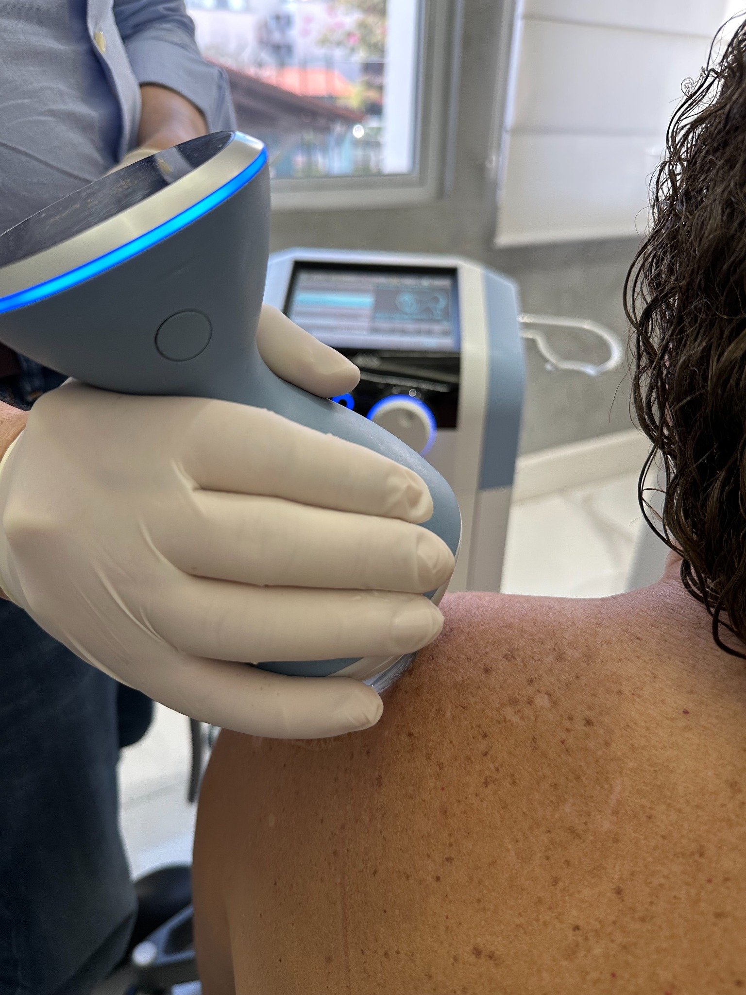 Aplicação de terapia por ondas de choque no ombro